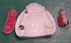 マグネット義歯例