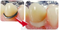 アセタル義歯