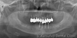 ミニインプラント義歯