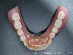 ミニインプラント義歯
