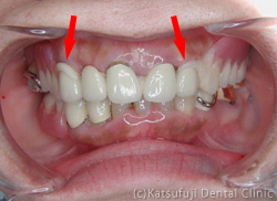 アセタル義歯