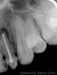 歯根端切除術、歯根のう胞摘出術症例