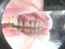 歯槽骨再生療法