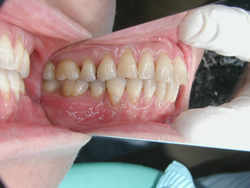 歯槽骨再生療法
